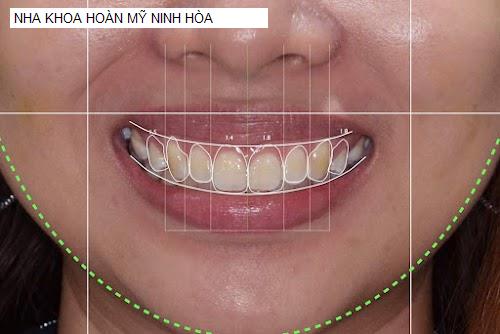 Hình ảnh NHA KHOA HOÀN MỸ NINH HÒA